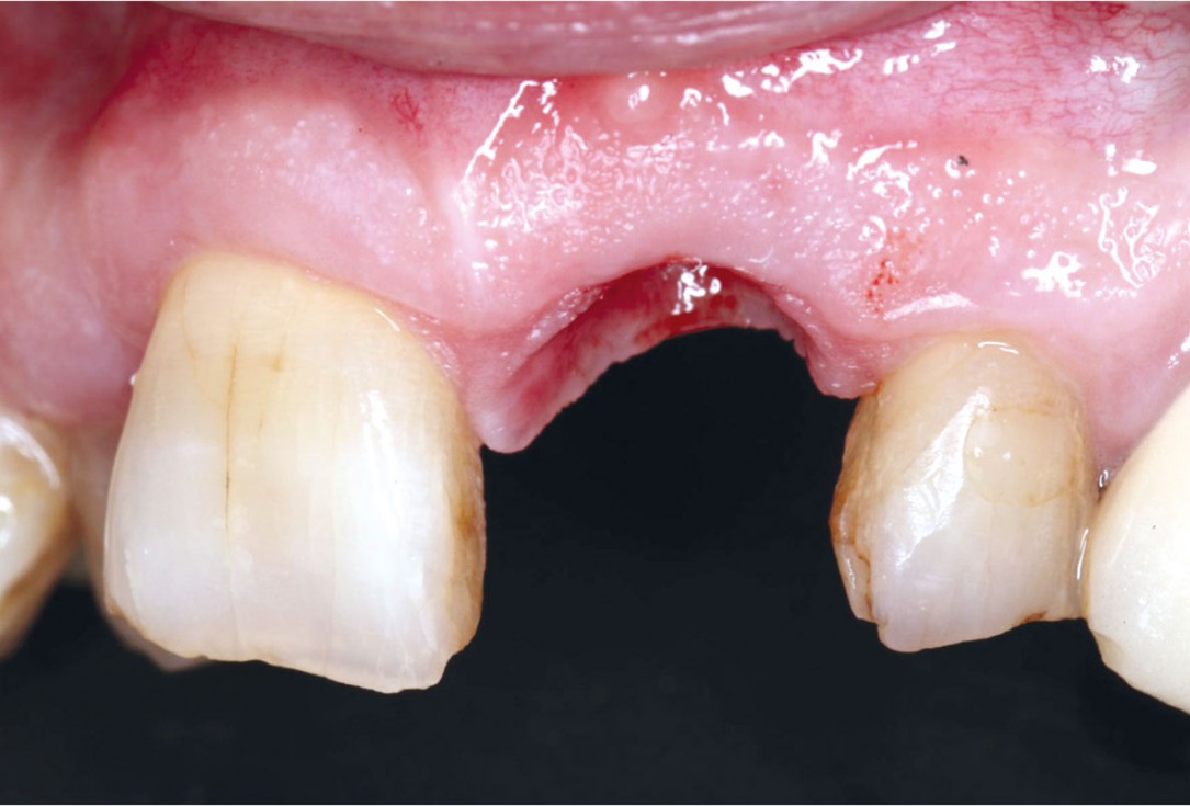 GBR using layering technique in aesthetic zone with maxgraft® and cerabone® -Dr. H. Maghaireh and Dr. V. Ivancheva