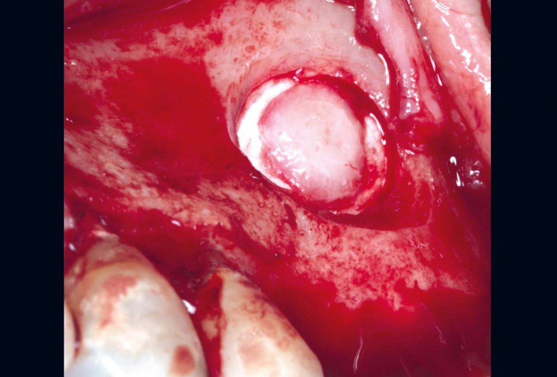 Maxillary sinus cyst removal using the Crocodile Technique and subsequent lateral sinus lift with cerabone®, maxgraft® and Jason® membrane - Dres. C. Scognamiglio and A. Perucchi 