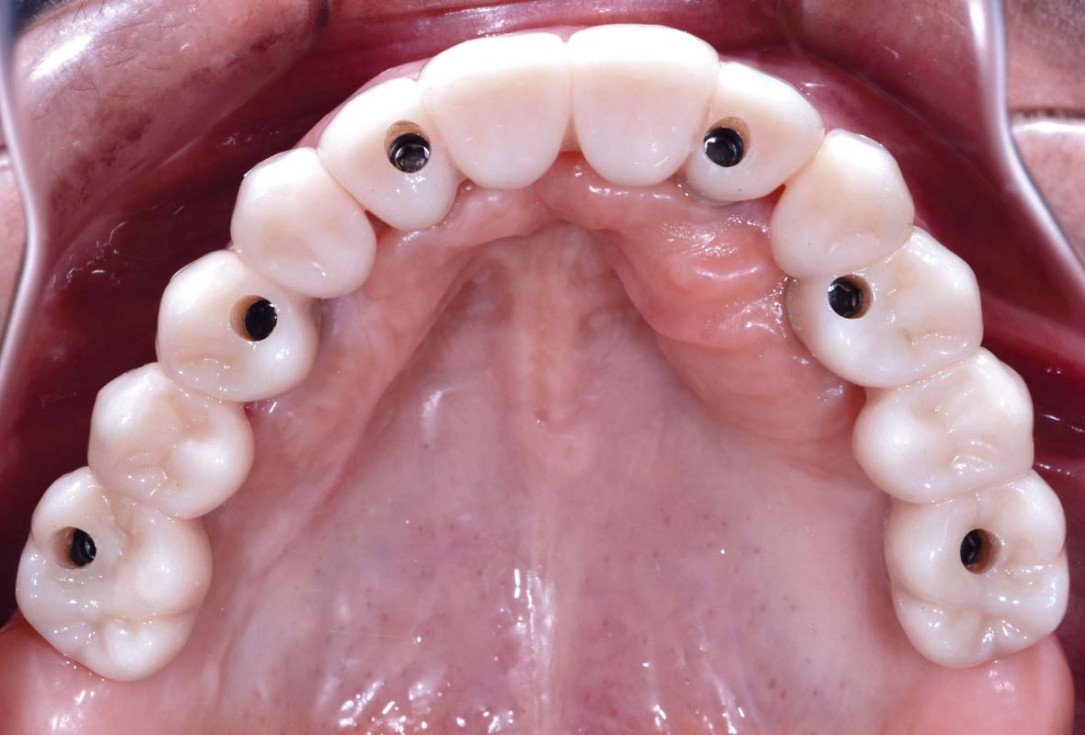 Full arch GBR using botiss cerabone®, maxgraft® and Jason® membrane with simultaneous implantation of 6 Straumann® implants - Dres. A. Signorio and G. Molina