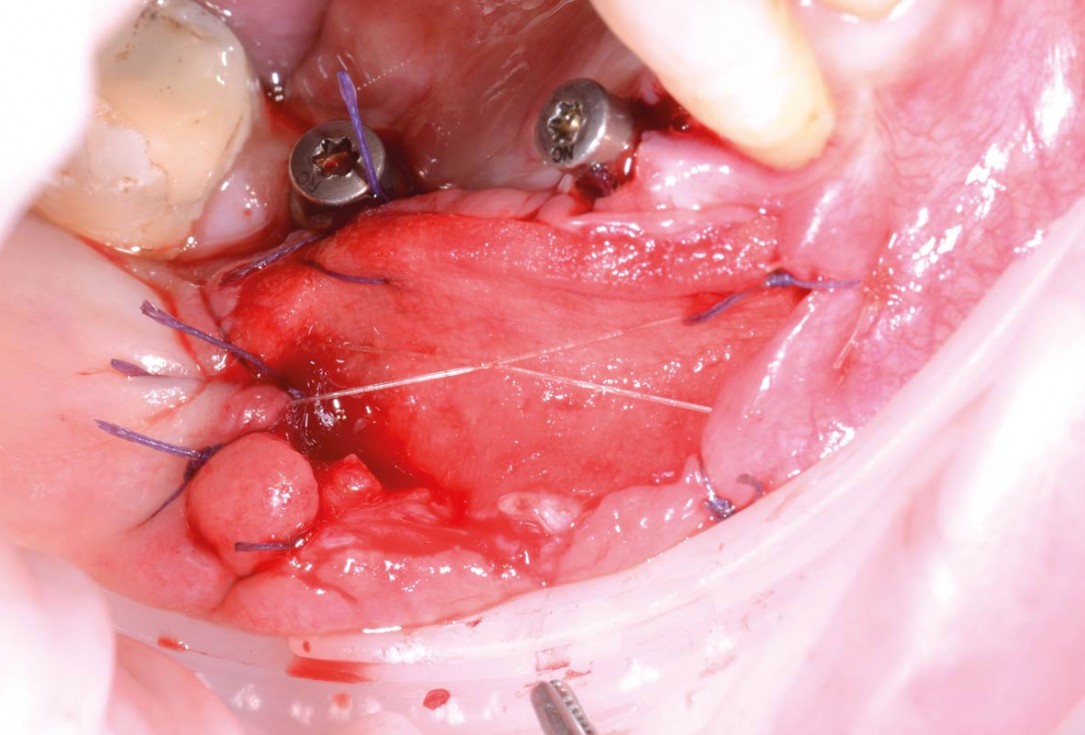 Vertical bone augmentation and broadening of attached gingiva using cerabone, permamem and mucoderm  -  Dr. R. Naimoli