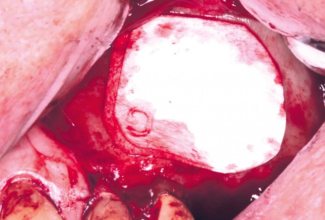 Maxillary sinus cyst removal using the Crocodile Technique and subsequent lateral sinus lift with cerabone®, maxgraft® and Jason® membrane - Dres. C. Scognamiglio and A. Perucchi 