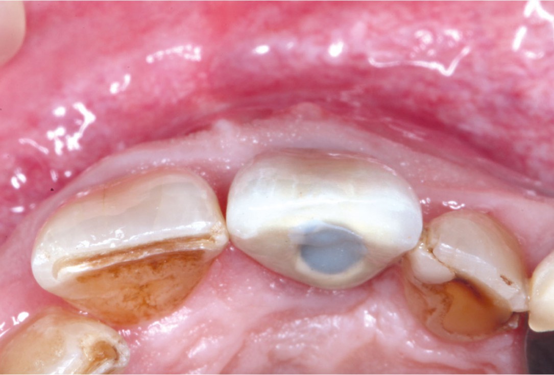 GBR using layering technique in aesthetic zone with maxgraft® and cerabone® -Dr. H. Maghaireh and Dr. V. Ivancheva
