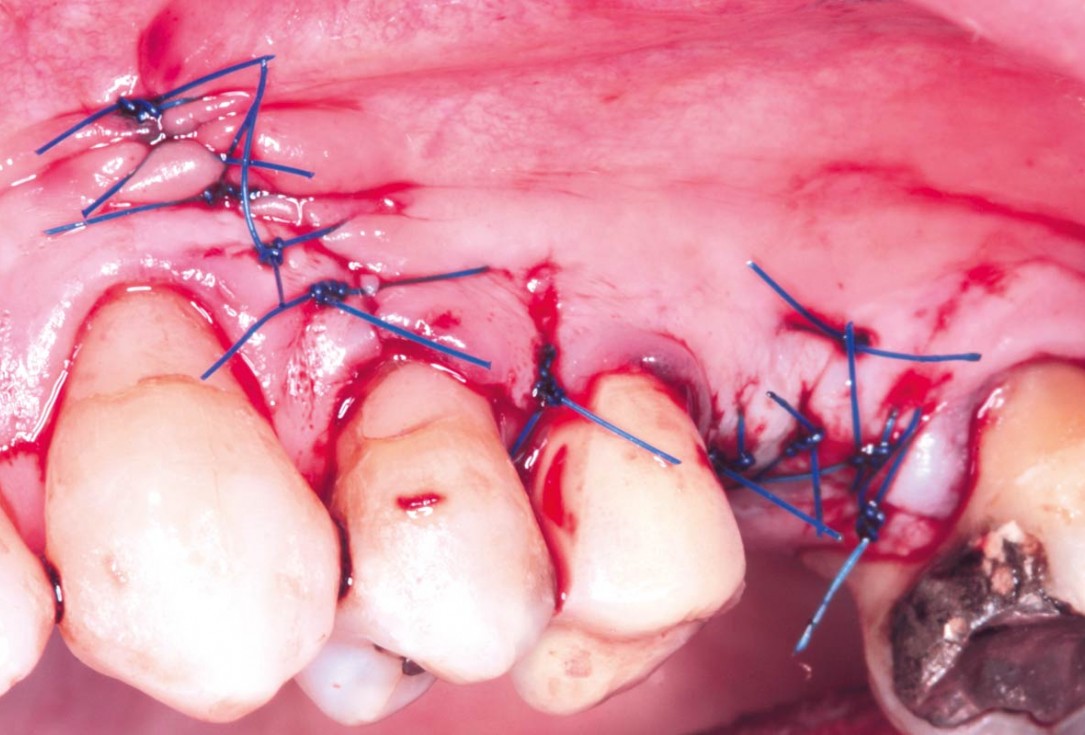 Maxillary sinus cyst removal using the Crocodile Technique and subsequent lateral sinus lift with cerabone®, maxgraft® and Jason® membrane - Dres. C. Scognamiglio and A. Perucchi 