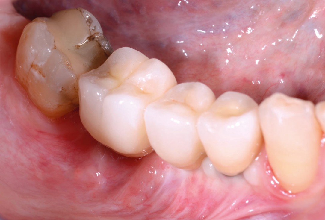 Vertical bone augmentation and broadening of attached gingiva using cerabone, permamem and mucoderm  -  Dr. R. Naimoli