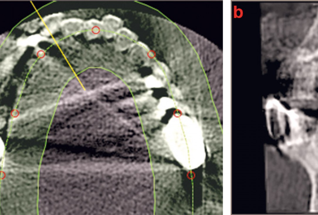 Three-dimensional augmentation with maxgraft® cortico - M.Sc. E. Kapogianni