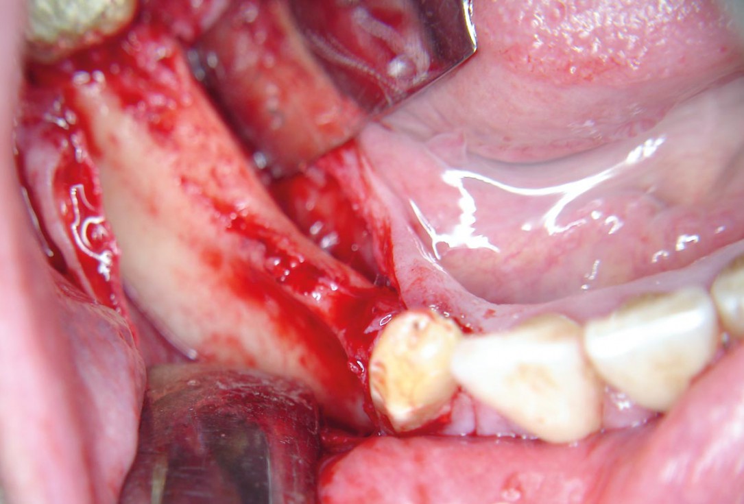 Horizontal ridge augmentation with maxgraft® cortico - M.Sc. E. Kapogianni