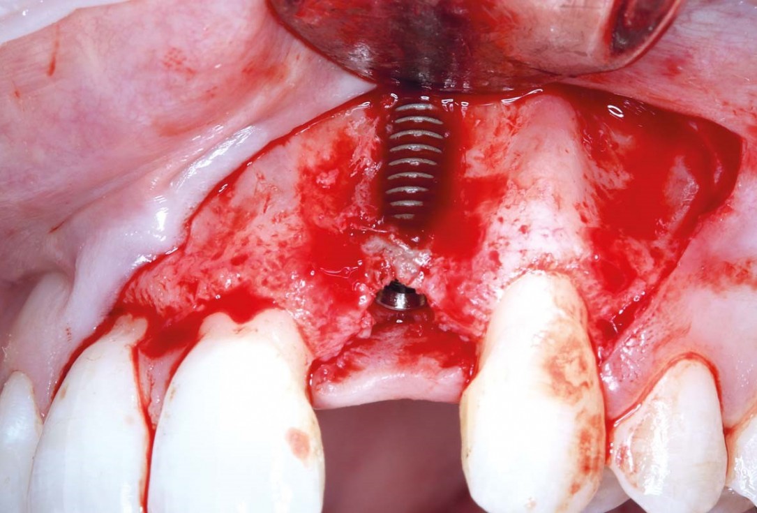Simultaneous GBR and implantation using maxgraft® granules and autologous bone