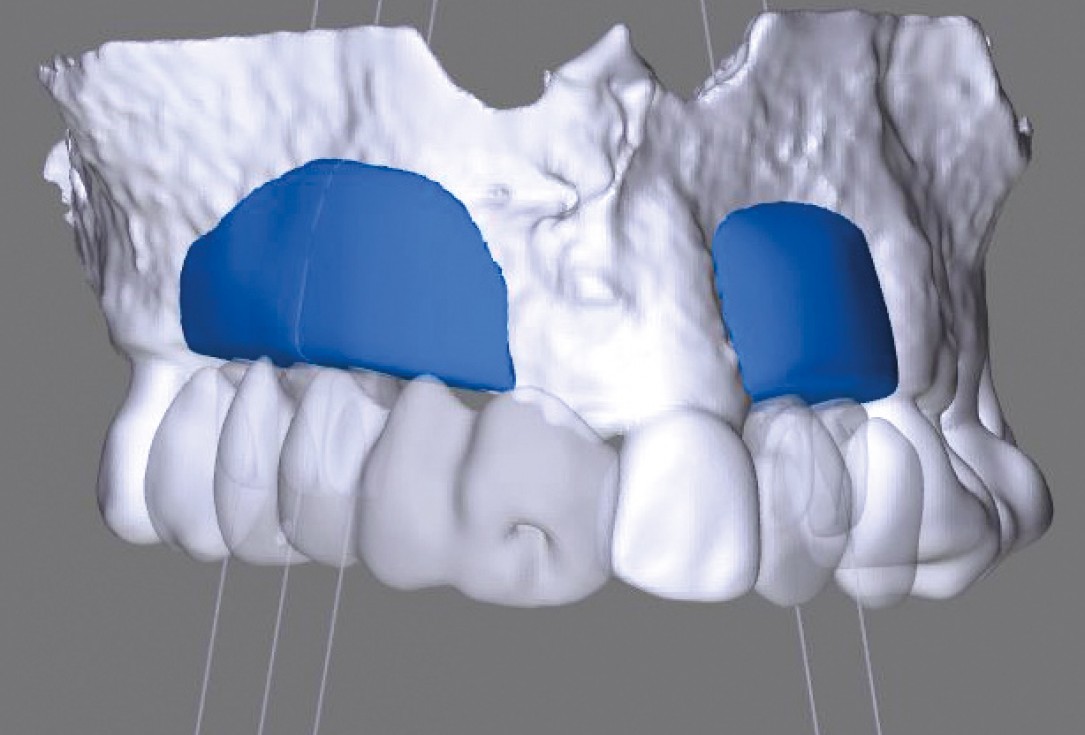 botiss maxgraft® bonebuilder for atrophic maxilla reconstruction - Clinical case