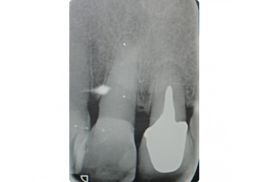 3/18 Tooth extraction and socket sealing with mucoderm® - Dr. A. Rossi