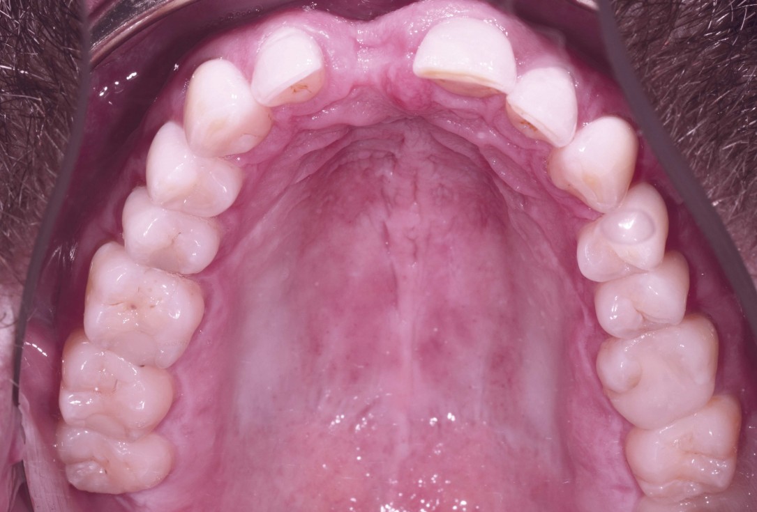 Block augmentation with maxgraft® and cerabone® – Dr. F. Kloss