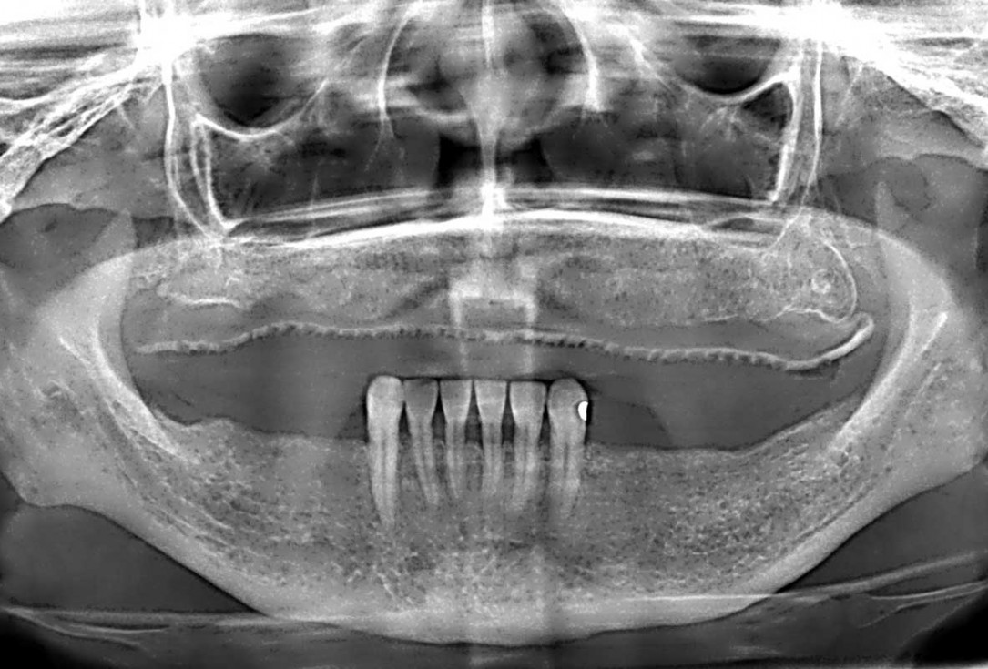 Full arch GBR using botiss cerabone®, maxgraft® and Jason® membrane with simultaneous implantation of 6 Straumann® implants - Dres. A. Signorio and G. Molina