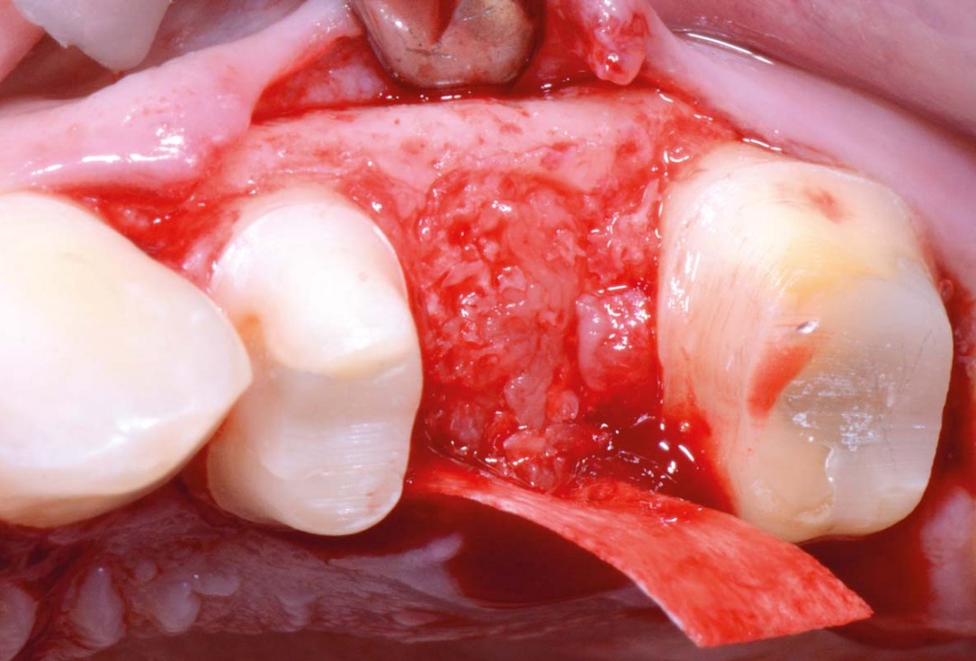 Full bone regeneration in extraction socket augmented with maxgraft® and Jason® membrane – Dr. C. Landsberg