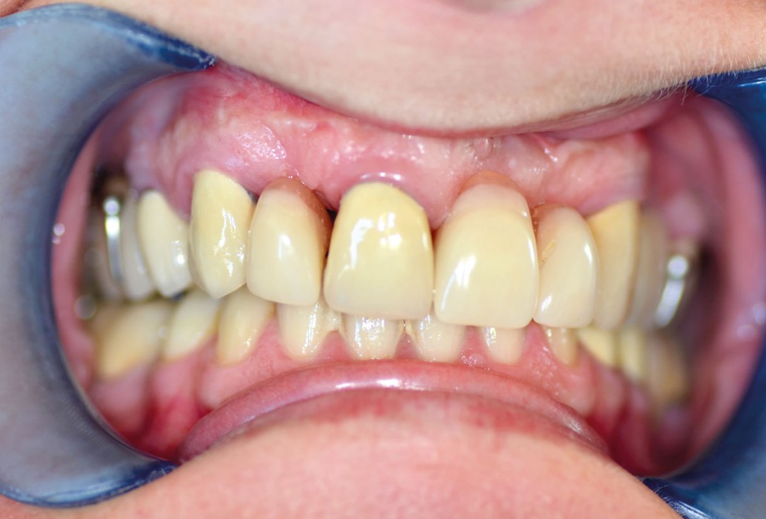 botiss maxgraft® bonebuilder for aesthetic zone reconstruction - Clinical case