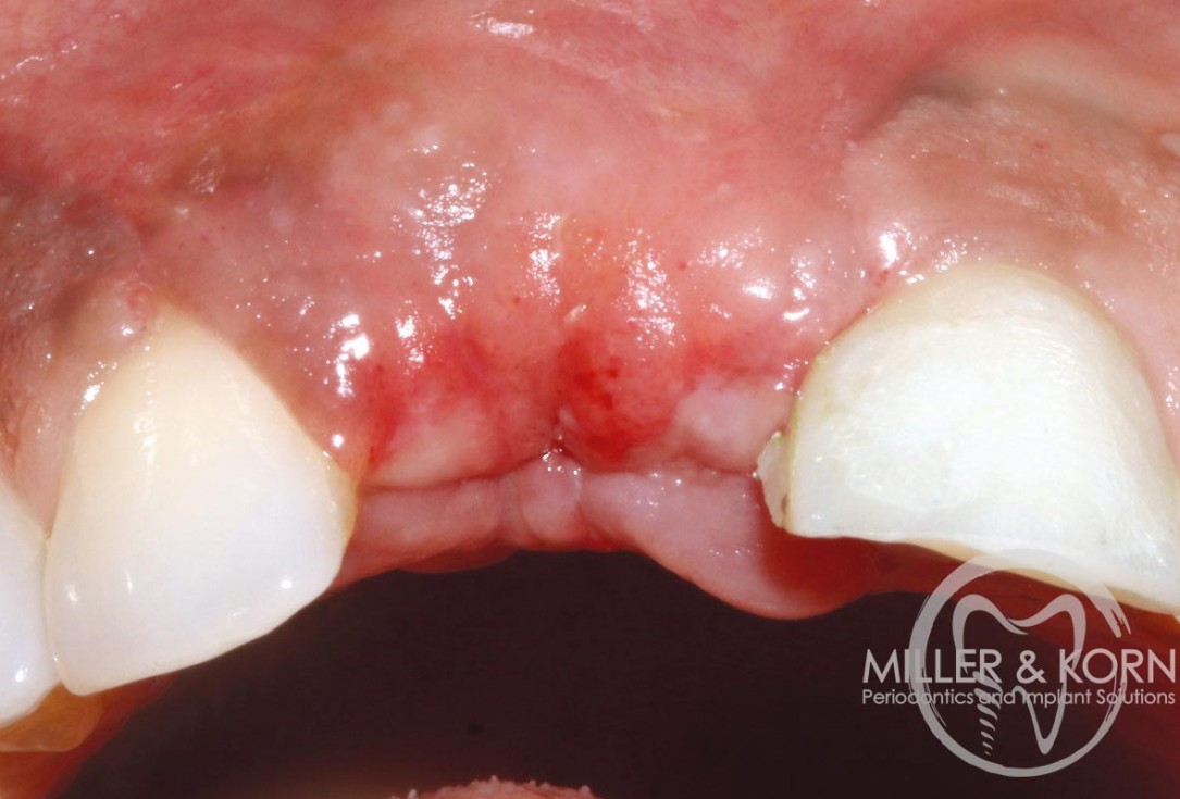 Immediate implant placement and regeneration of ridge using an allograft bone ring and Jason® membrane - Dr. Miller and Korn