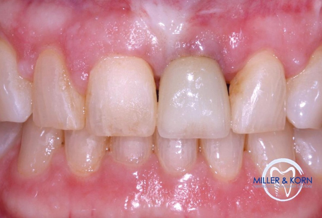 Immediate implant placement and correction of horizontal and vertical bone loss using an allograft bone ring, cerabone® and Jason® membrane - Drs. Miller and Korn