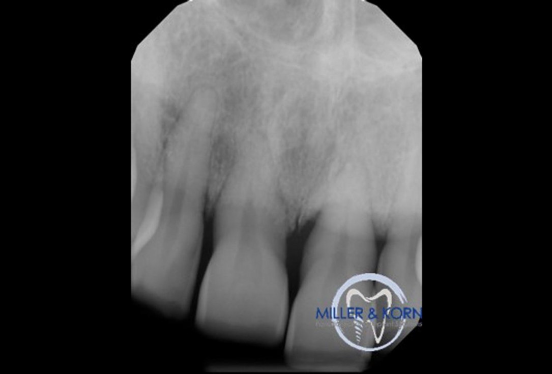 Immediate implant placement and correction of horizontal and vertical bone loss using an allograft bone ring, cerabone® and Jason® membrane - Drs. Miller and Korn