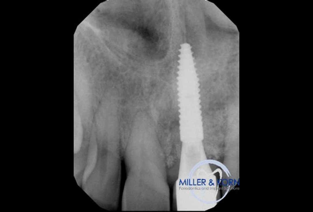 Immediate implant placement and correction of horizontal and vertical bone loss using an allograft bone ring, cerabone® and Jason® membrane - Drs. Miller and Korn