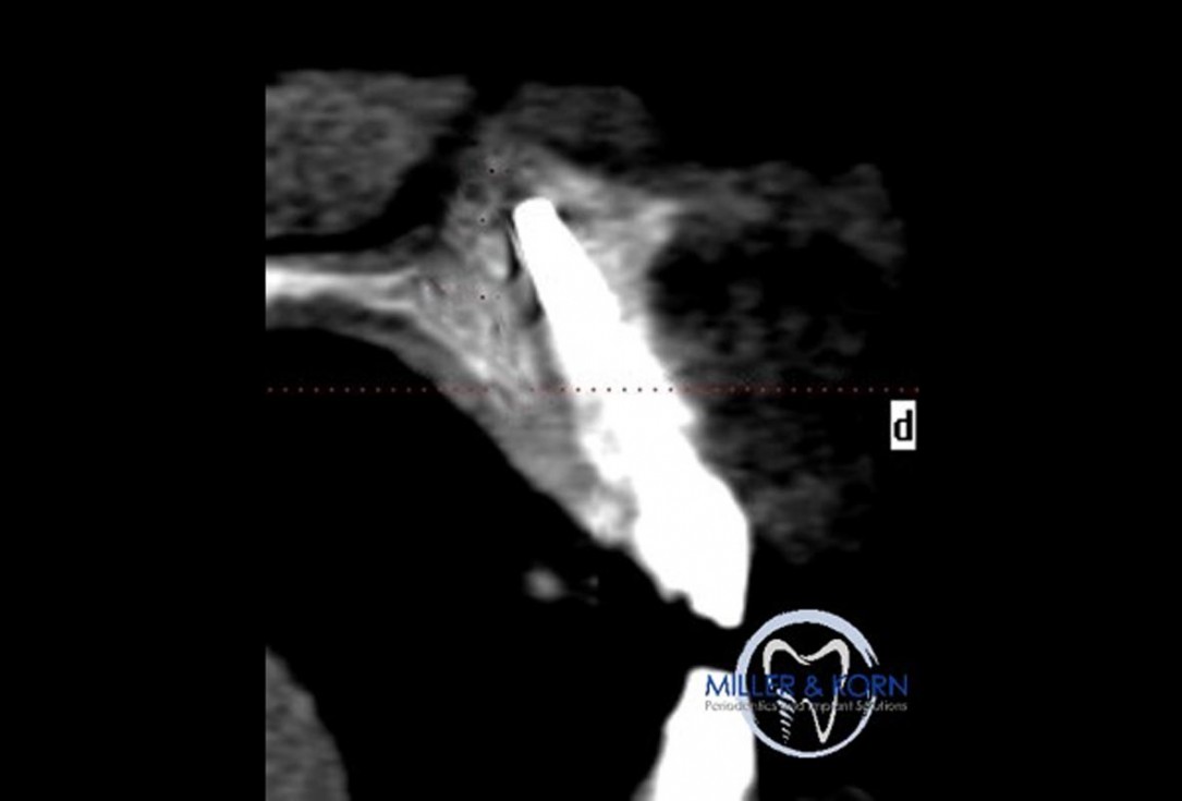 Immediate implant placement and correction of horizontal and vertical bone loss using an allograft bone ring, cerabone® and Jason® membrane - Drs. Miller and Korn