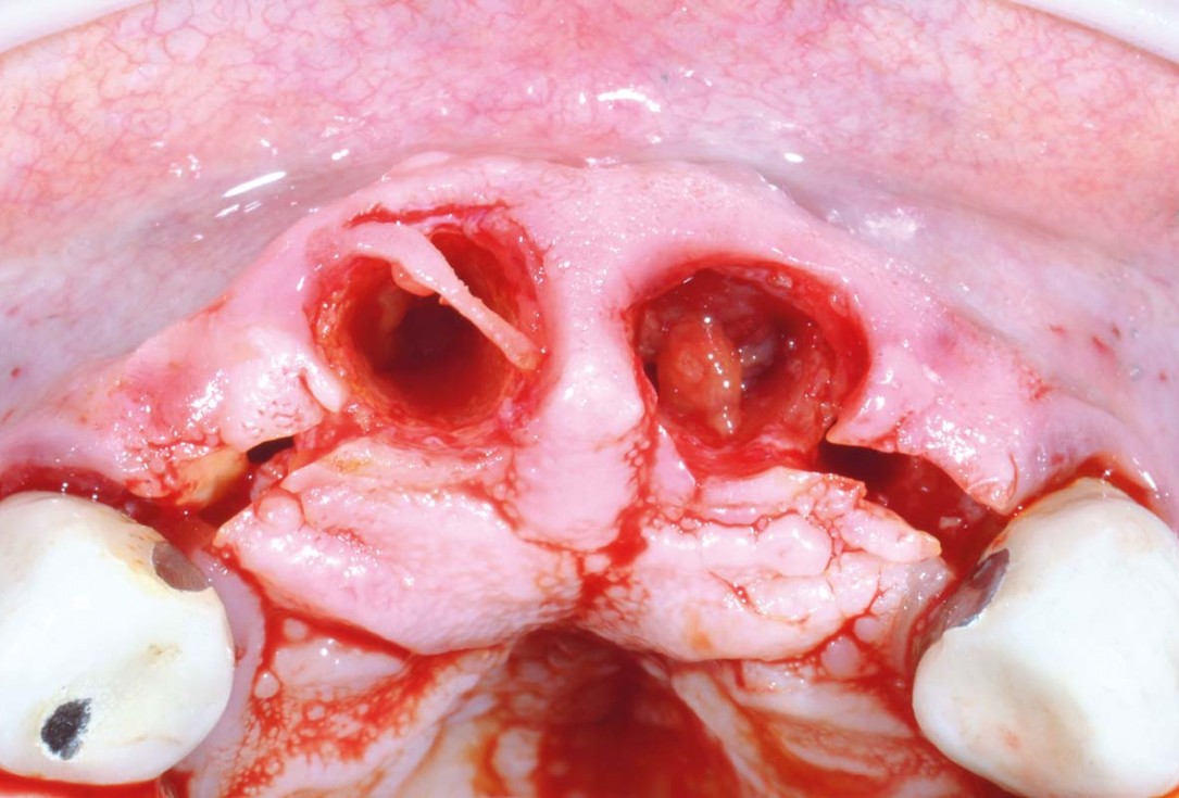 Hard and soft tissue management in immediate restoration