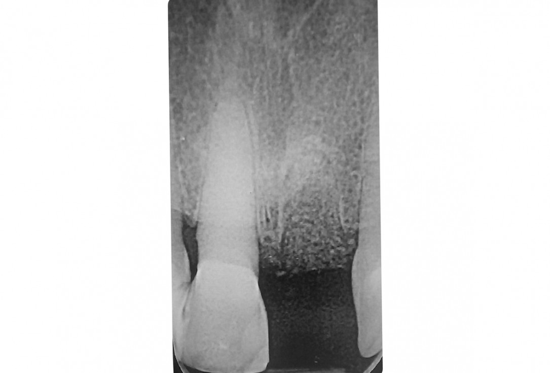 4/18 Tooth extraction and socket sealing with mucoderm® - Dr. A. Rossi