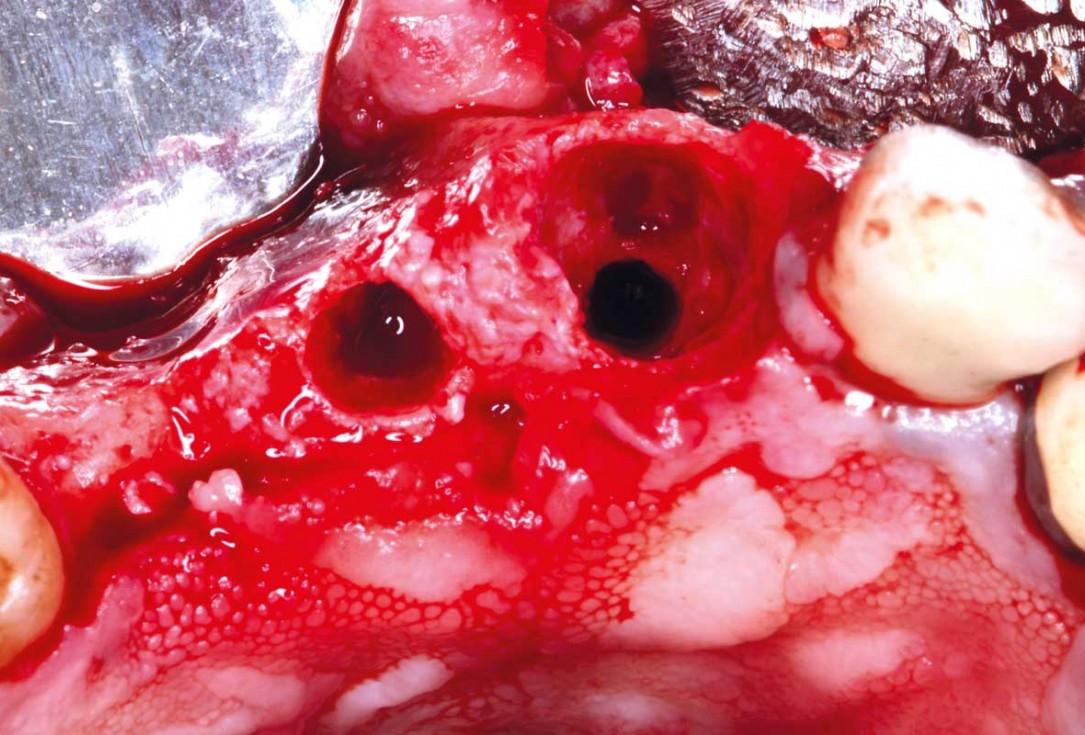 GBR and soft tissue augmentation with cerabone® and mucoderm® - H. Maghaireh & V. Ivancheva