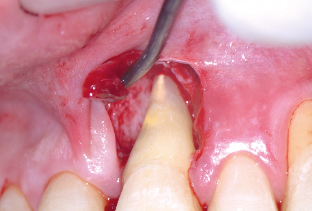 EPP for the treatment of a deep intrabony defect 