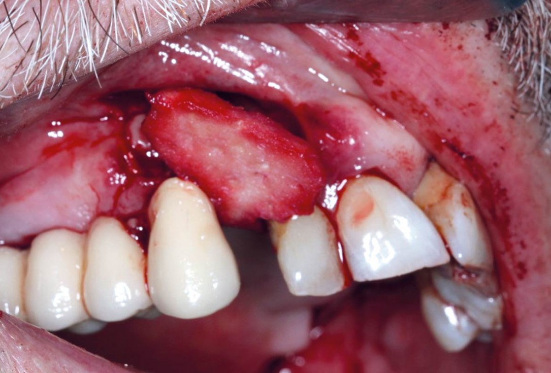 Regeneration with mucoderm® after fibroma resection