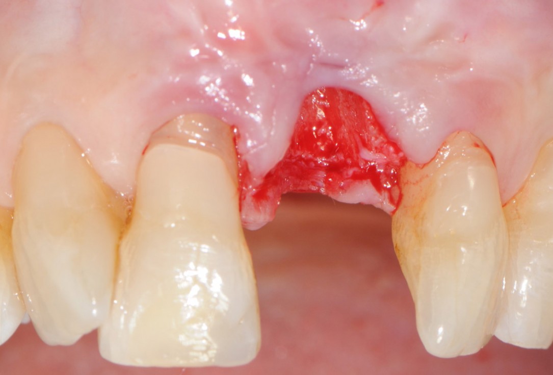 5/18 Tooth extraction and socket sealing with mucoderm® - Dr. A. Rossi