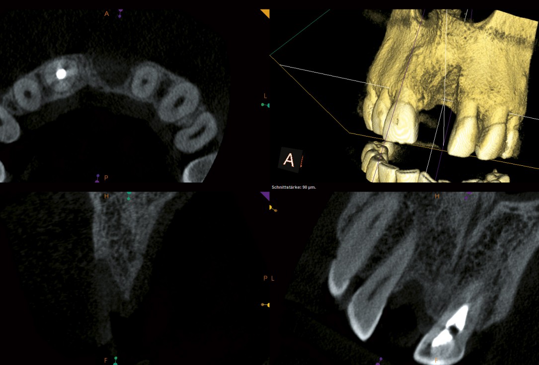 Block augmentation with maxgraft® and cerabone® – Dr. F. Kloss