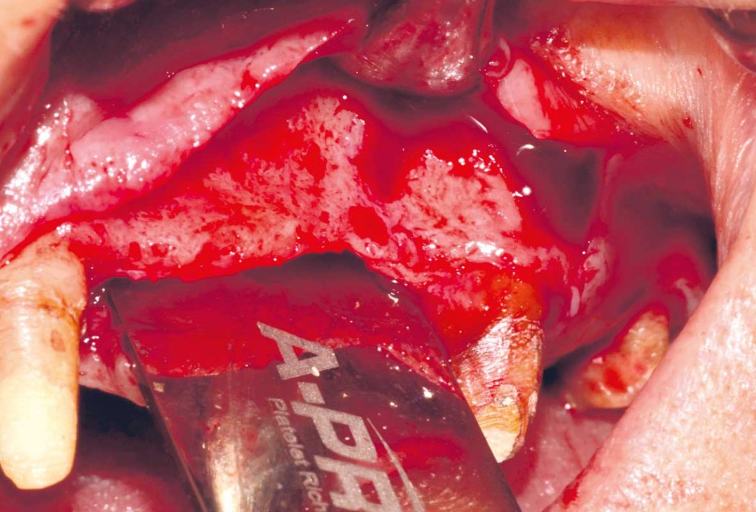 Reconstruction of Anterior Maxilla with maxgraft® bonebuilder – Dr. B. Han