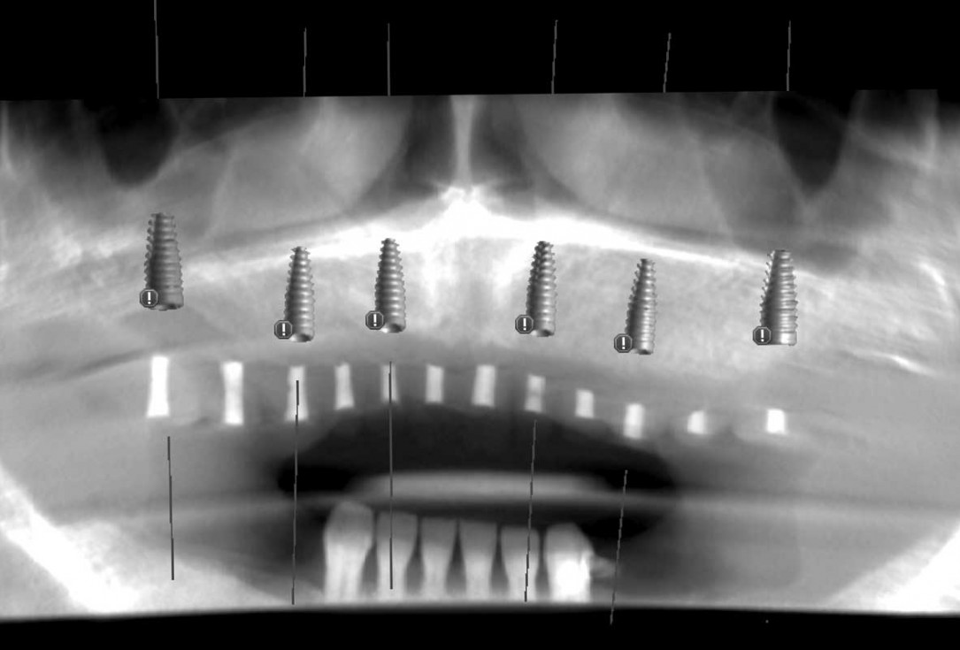 Full arch GBR using botiss cerabone®, maxgraft® and Jason® membrane with simultaneous implantation of 6 Straumann® implants - Dres. A. Signorio and G. Molina