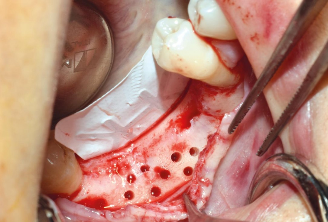 GBR with cerabone® and titanium reinforced PTFE membrane - DentalPro - A. Marchetta