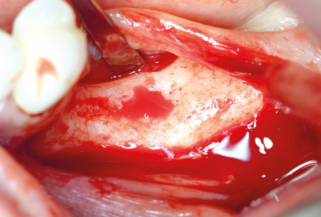 Ridge augmentation in the mandible with maxgraft® bonebuilder in a free-end situation - Dr. Dr. Dr. O. Blume
