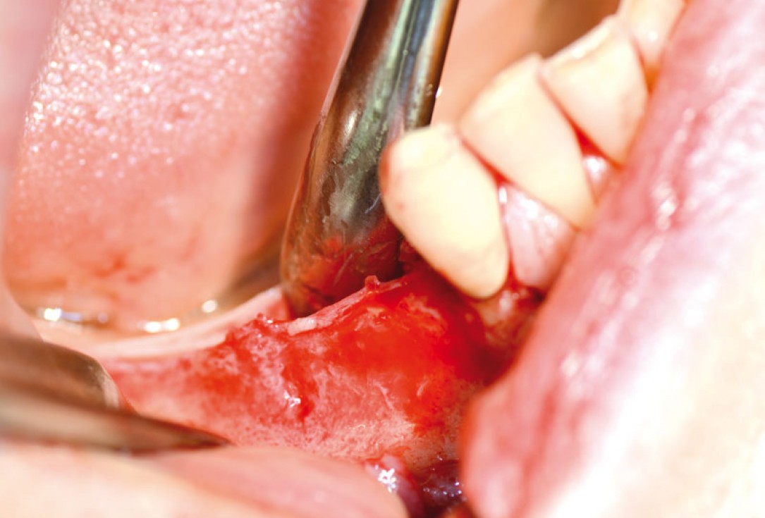 Block augmentation with maxgraft® in the mandible - PD Dr. Dr. F. Kloss
