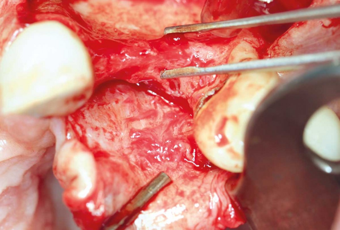 botiss maxgraft® bonebuilder for atrophic maxilla reconstruction - Clinical case