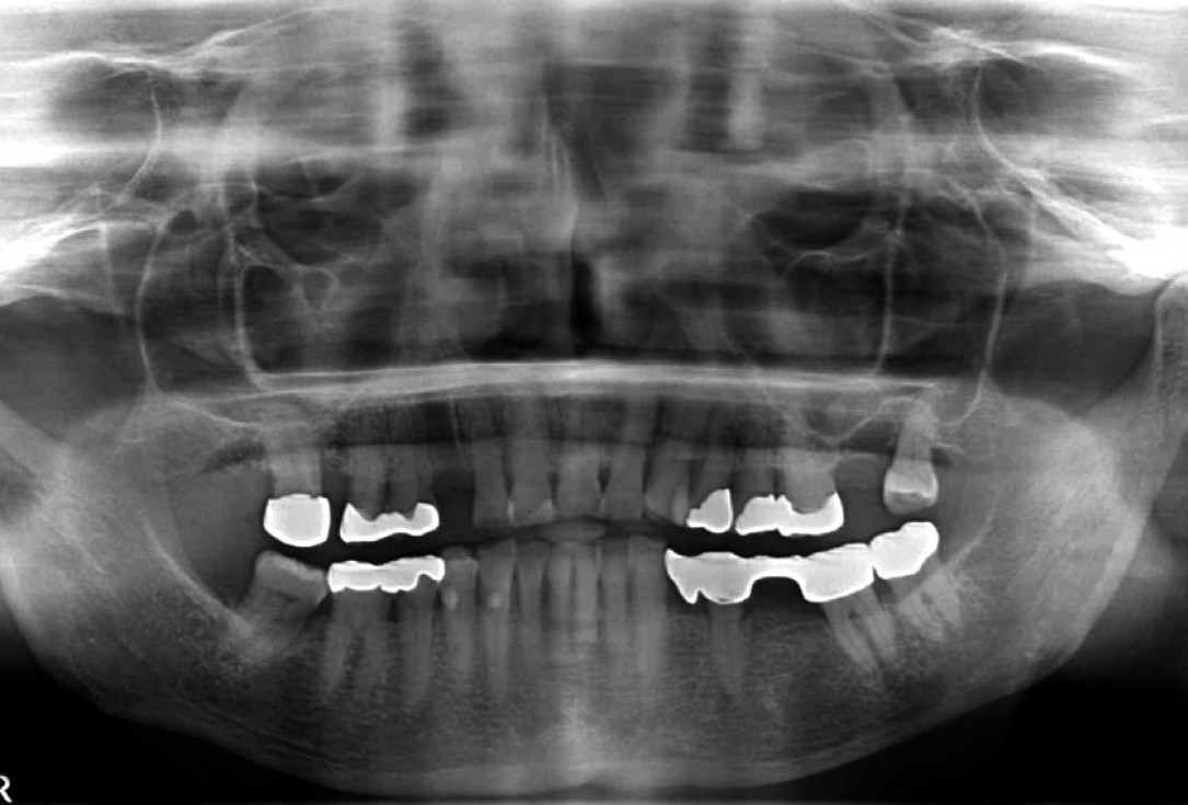 Block augmentation with maxgraft® in the maxilla - PD Dr. Dr. F. Kloss
