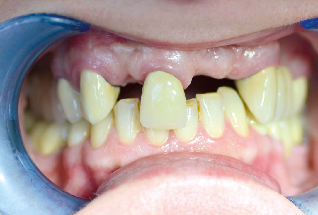 botiss maxgraft® bonebuilder for aesthetic zone reconstruction - Clinical case