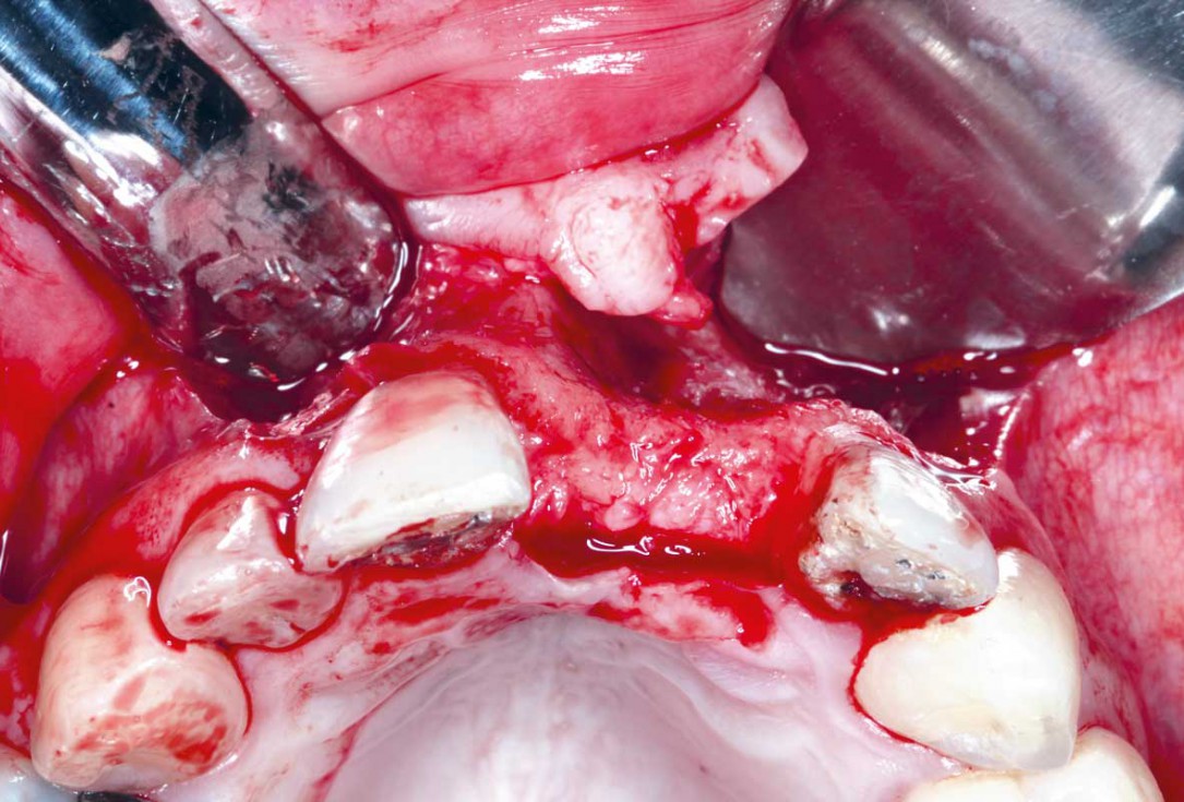 Block grafting in the aesthetic zone with maxgraft®, Jason® membrane and cerabone® - Dres. H. Maghaireh and V. Ivancheva