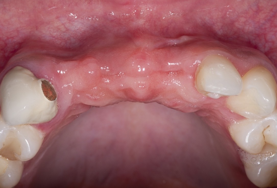 Block augmentation with maxgraft® block and mucoderm® - Dr. K. Chmielewski