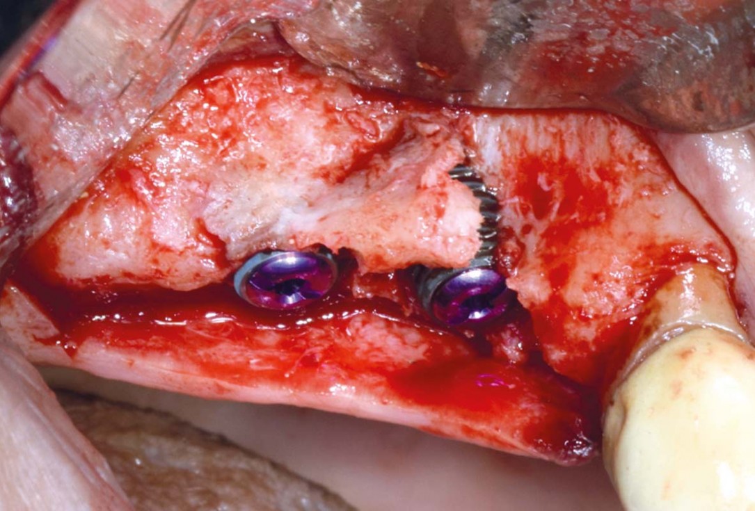 GBR with Jason membrane® and cerabone® - D. Fontana