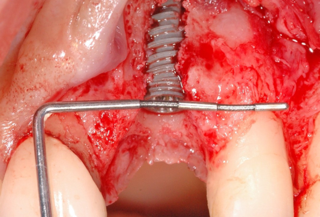 GBR together with soft tissue augmentation with mucoderm® and maxresorb® - Scherg