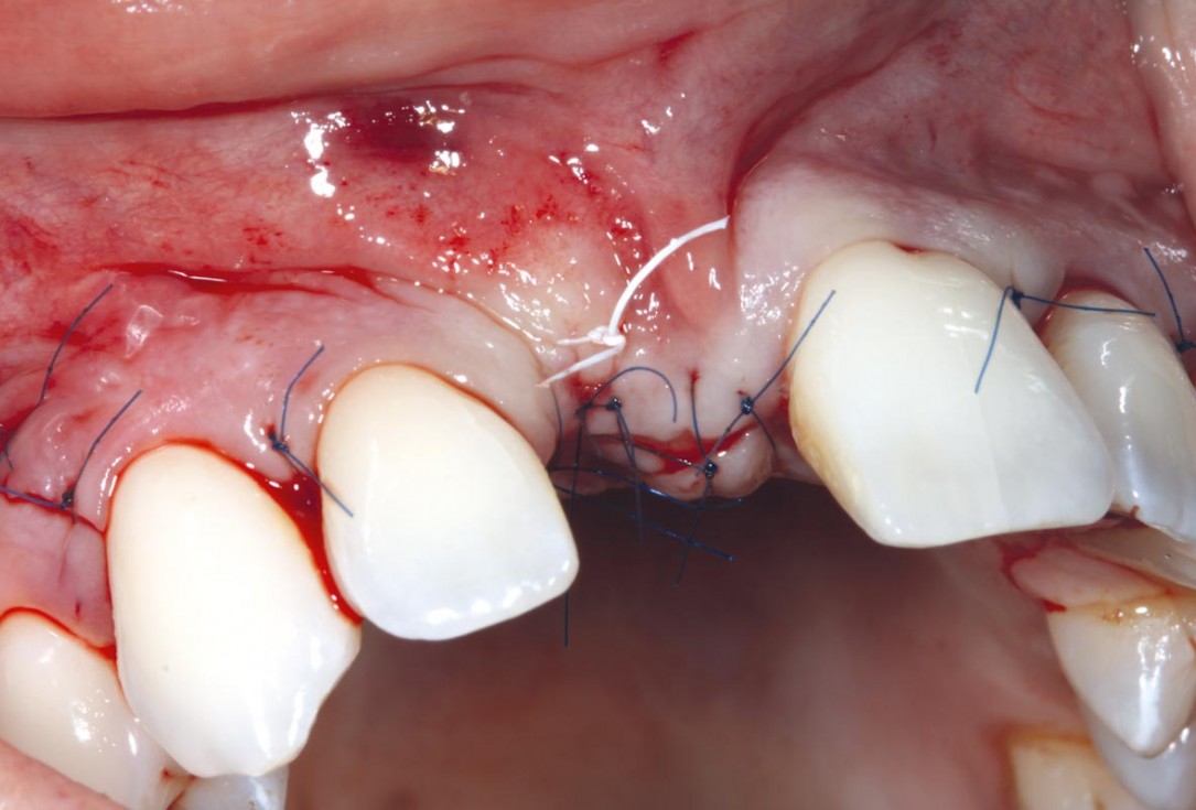 6/11 maxgraft® cortico at combined defect palatally and facially - Dr. K. Höckl