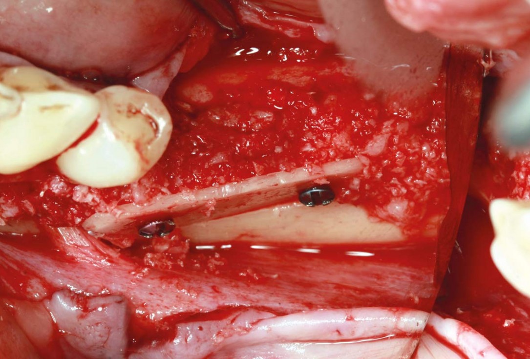 maxgraft® cortico at free-end situation in the mandible - J. Kielhorn