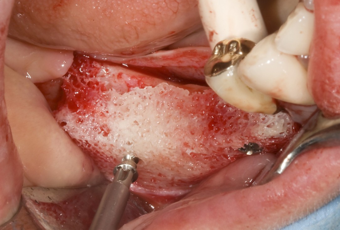 Ridge augmentation with maxgraft® bonebuilder - Dr. M. Jacotti