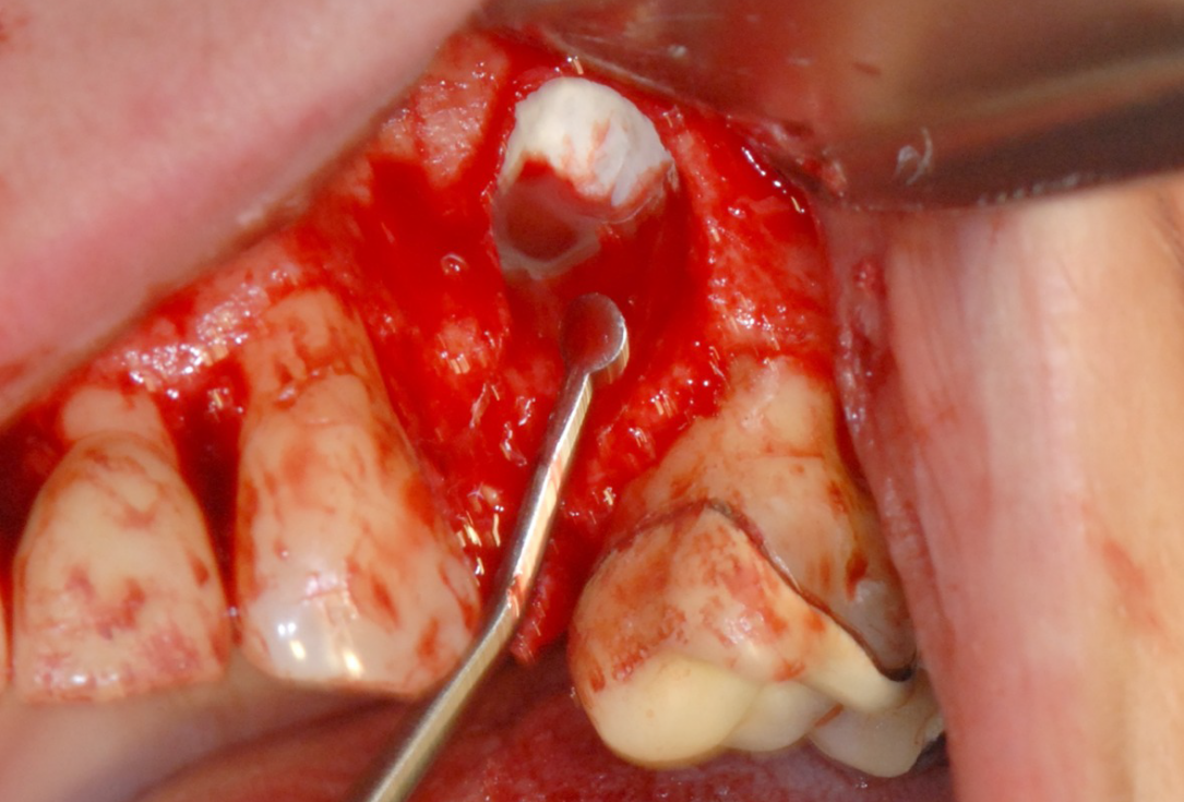 Ridge preservation with cerabone® and Jason® membrane - Dr. Derk Siebers