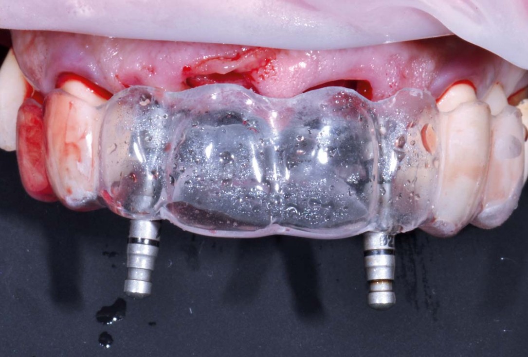 Hard and soft tissue management in immediate restoration