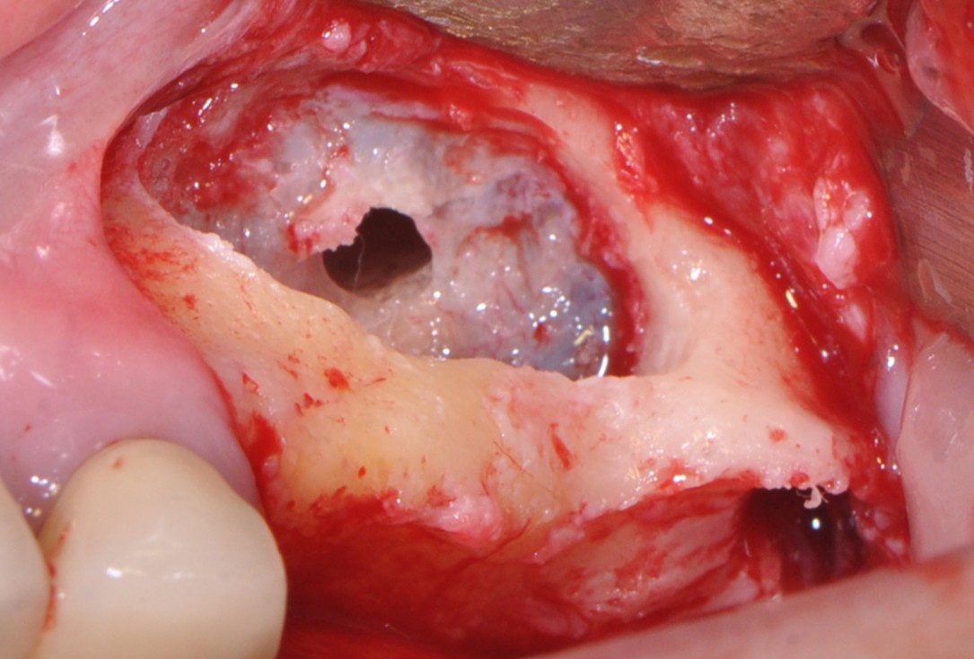 Sinus lift with simultaneous implantation with cerabone® and collprotect® membrane - clinical case Dr. Victor Kalenchuk