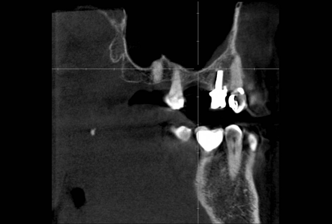 Maxillary sinus cyst removal using the Crocodile Technique and subsequent lateral sinus lift with cerabone®, maxgraft® and Jason® membrane - Dres. C. Scognamiglio and A. Perucchi 