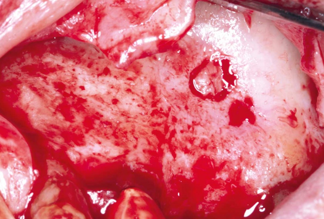 Maxillary sinus cyst removal using the Crocodile Technique and subsequent lateral sinus lift with cerabone®, maxgraft® and Jason® membrane - Dres. C. Scognamiglio and A. Perucchi 