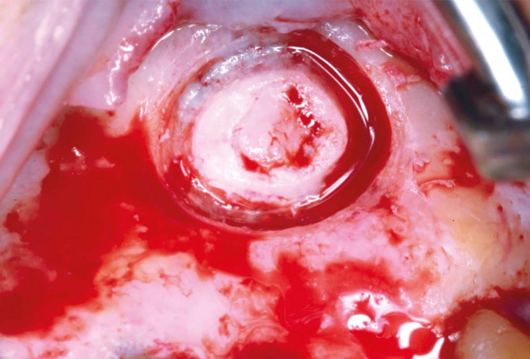Maxillary sinus cyst removal using the Crocodile Technique and subsequent lateral sinus lift with cerabone®, maxgraft® and Jason® membrane - Dres. C. Scognamiglio and A. Perucchi 